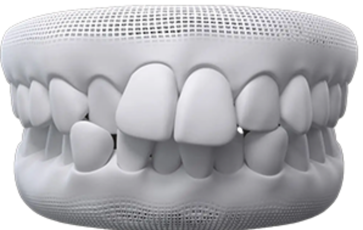 invisalign before after