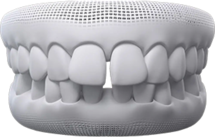 invisalign before after