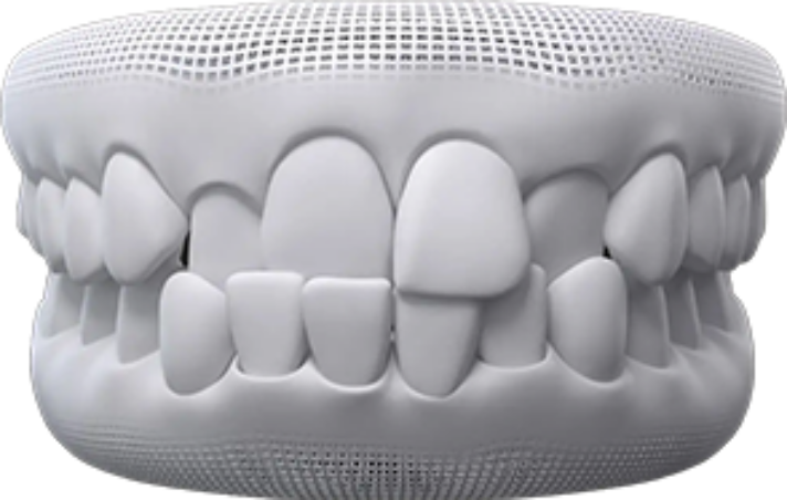 invisalign before after