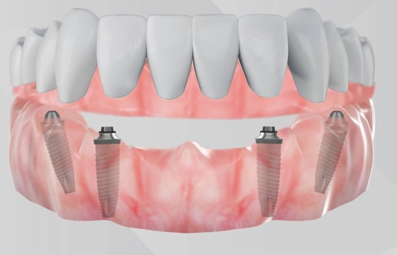 Treatment Preview Image