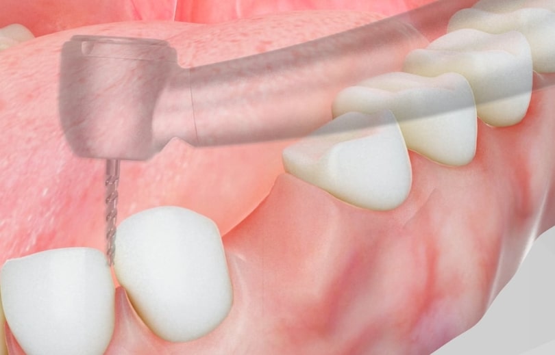 Treatment Preview Image