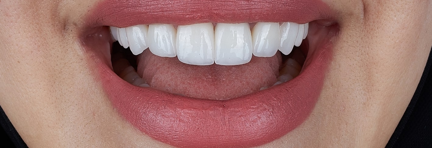 Treatment Inner Image - Haymarket Dental