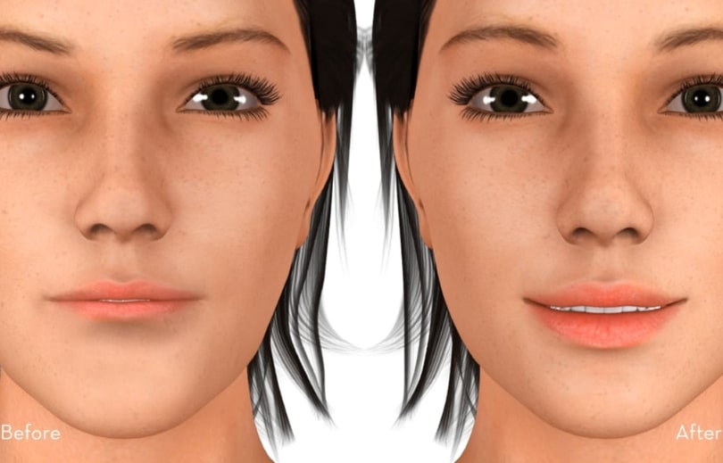 Treatment Preview Image