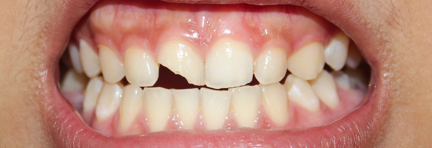 Treatment Inner Image - Haymarket Dental
