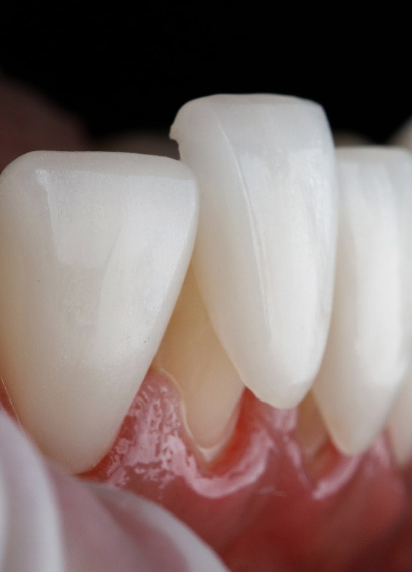 Treatment - Haymarket Dental