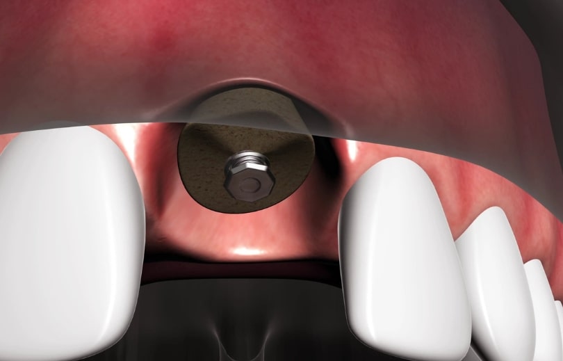 Treatment Preview Image