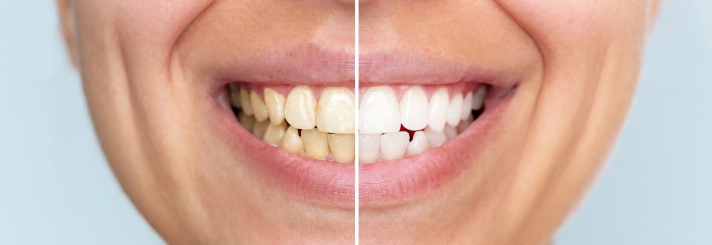 Treatment Inner Image - Haymarket Dental