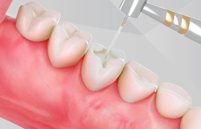 Treatment Preview Image