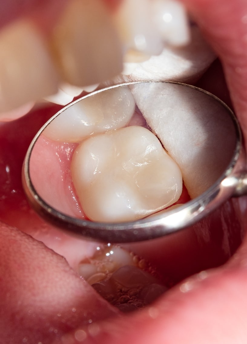 Treatment - Haymarket Dental